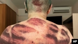 Novaya gazeta journalist Yelena Milashina shows her bruised back after receiving medical treatment in Moscow on July 5. She said around 10 to 15 attackers beat her with plastic pipes.